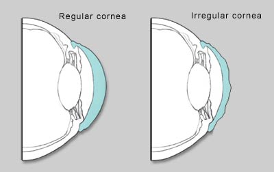 An astigmatic cornea is irregularly shaped, causing blurred or 